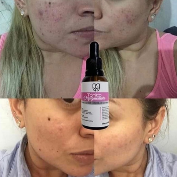 LB Tónico Despigmentante🇨🇴* Eliminador de manchas* Removes dark spots + … - Picture 10 of 15